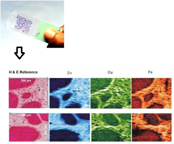 A selection of 100 different tumour sections on one glass slide. Bottom – The boxes on the left demarcate the tumour areas (darker colour), and the three boxes to the right show metal concentration (also darker colour) in virtually the same area. Image courtesy of Tina Geraki, Adrian Harris, and Michael Farquharson