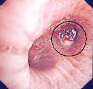 Figure 1. Bronchoscopy image of a lung tumour appearing as a white mass. The tumour has been circled for clarity [5].