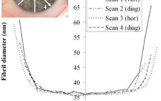 Improving corneal surgery