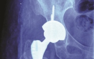 One step closer to preventing hip implant replacements