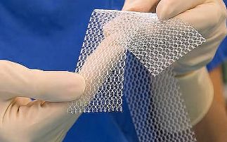Diamond’s crucial role in revealing pelvic mesh degradation