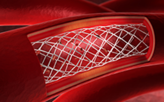 Improving the design and production of dissolvable stents to treat damaged arteries