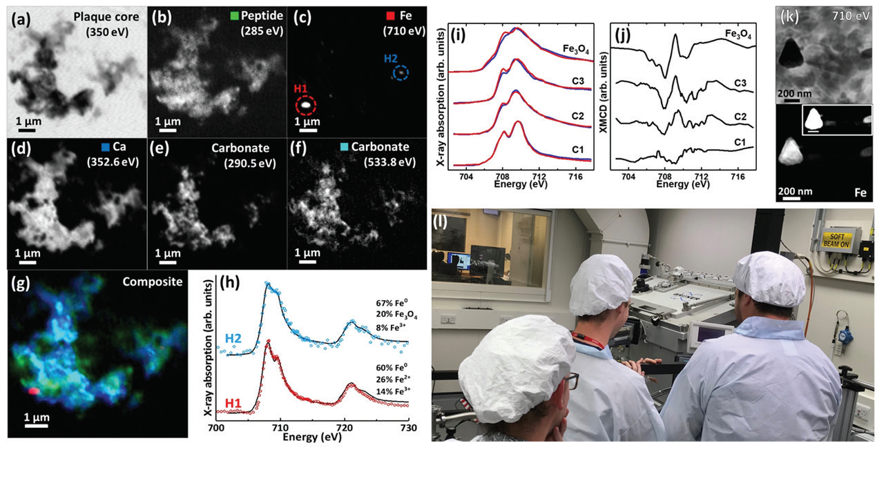 Figure 1: STXM image (a),
<br/>speciation maps (b-f) and
<br/>composite image (g) of amyloid
<br/>plaque core material from an AD
<br/>subject. (h) Iron L<sub>2,3</sub>
<br/>-edge X-ray
<br/>absorption spectra from the
<br/>areas highlighted in (c), showing
<br/>the presence of chemically-reduced
<br/>iron. (i) Iron L<sub>3</sub>-
<br/>edge
<br/>X-ray absorption spectra and
<br/>corresponding XMCD spectra (j)
<br/>from amyloid plaque core iron
<br/>deposits, compared to a magnetite
<br/>standard (Fe<sub>3</sub>O<sub>4</sub> ). (k) Ptychography
<br/>710 eV image (top) and iron
<br/>L3-edge speciation map (bottom)
<br/>from an amyloid plaque core iron
<br/>oxide inclusion. (l) Research team
<br/>members watch a fragile sample
<br/>being loaded into the I08 STXM.