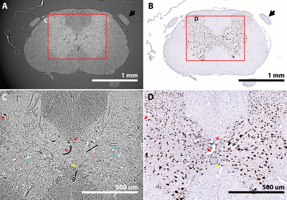 Figure 2: After 3D imaging a spinal cord sample by (a, c) SR-μCT, tissue can be sectioned and
<br/>probed by (b, d) 2D histology. Tomography and histology can be aligned by features within
<br/>samples including vasculature (red arrows) and the central canal (yellow arrow). Cell bodies
<br/>are also apparent (blue arrows). (b, d) Immunolabelling for NeuN (a marker for neuronal cell
<br/>bodies) confirms tissue is viable for histology after 3D scanning.