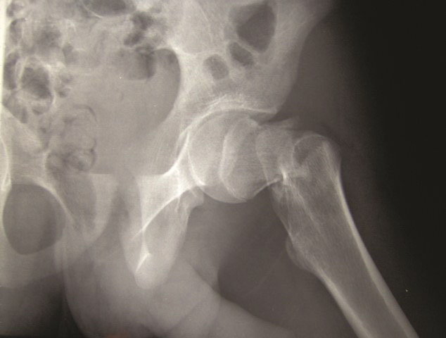 Hip fracture