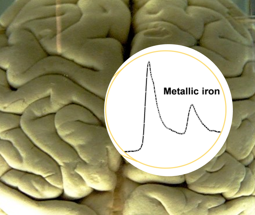 Image Discovering microscopic metallic particles in the brain