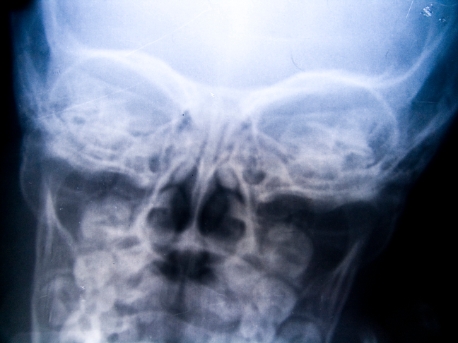 x-ray of skull